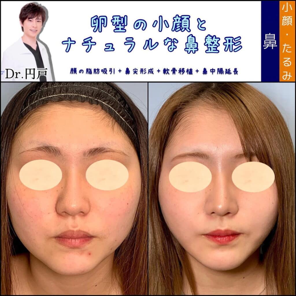 eclinic京都院の顔の脂肪吸引と鼻尖形成と軟骨移植と鼻中隔延長の症例写真