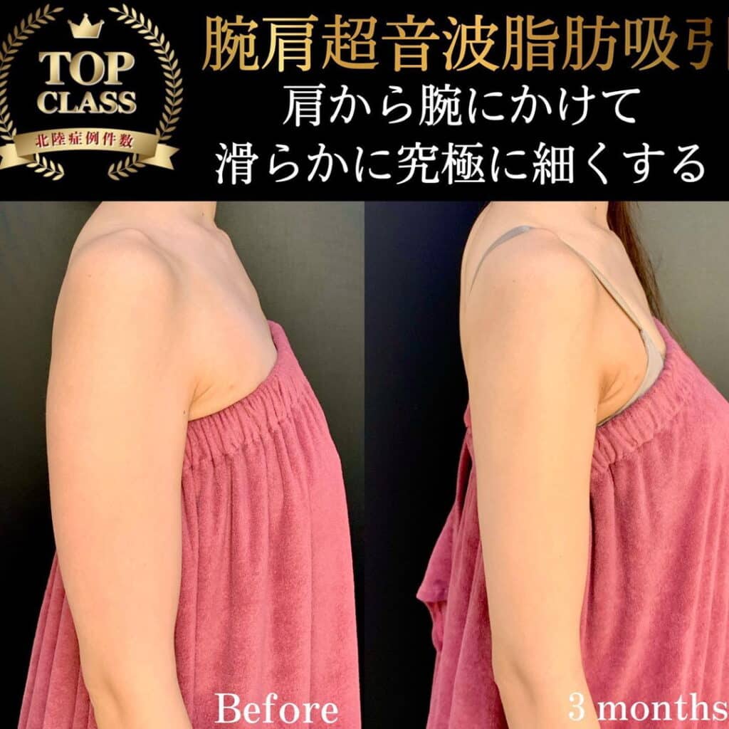 eclinic京都院の腕脂肪吸引の症例写真