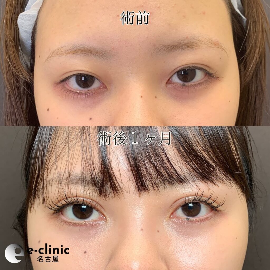 eclinic京都院の全切開二重術