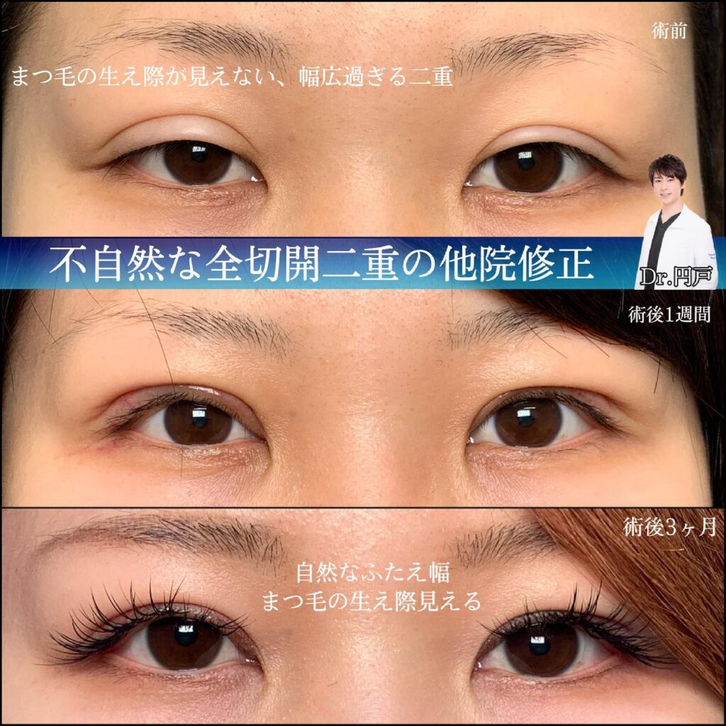 eclinic京都院の全切開二重術の他院修正