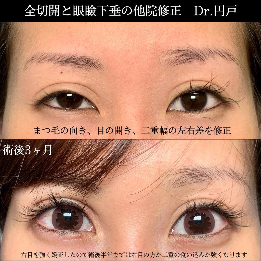 eclinic京都院の全切開二重術の他院修正+眼瞼下垂