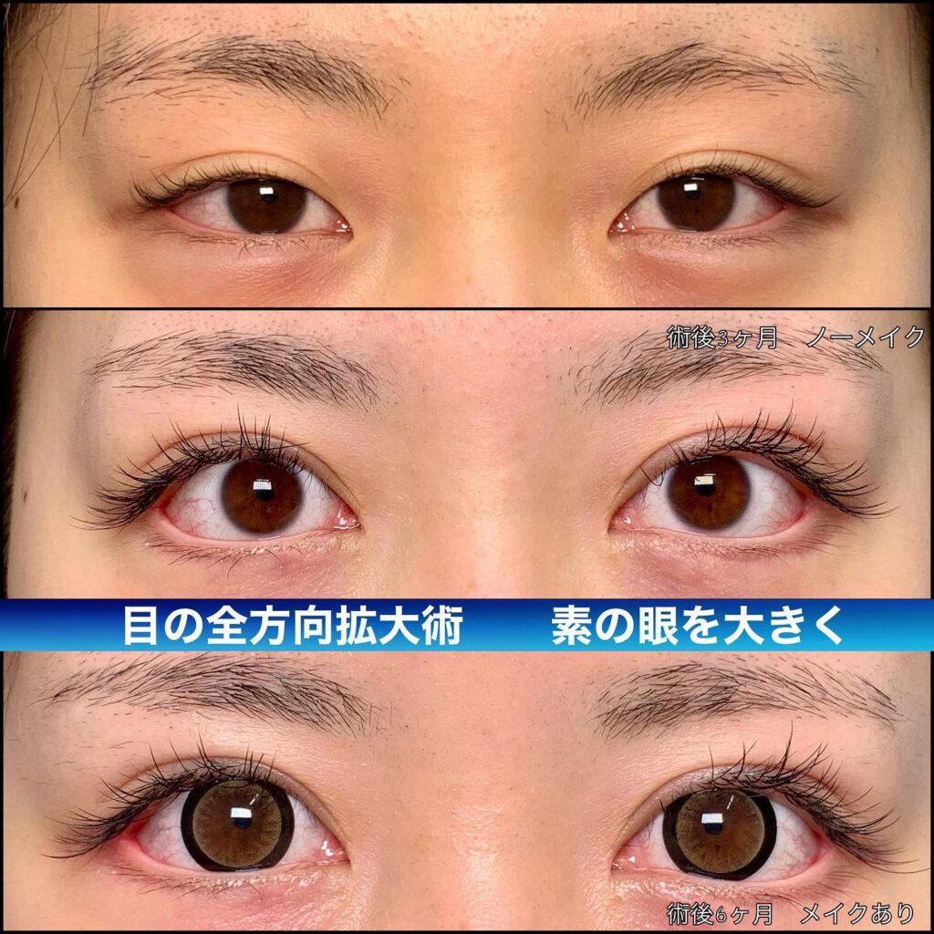 eclinic京都院の全切開二重術