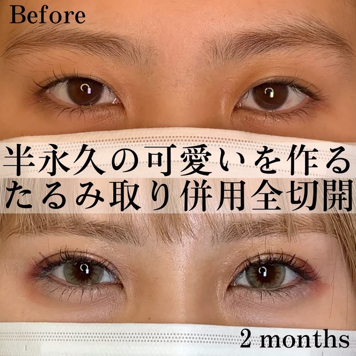eclinic京都院のたるみ取り併用全切開二重術