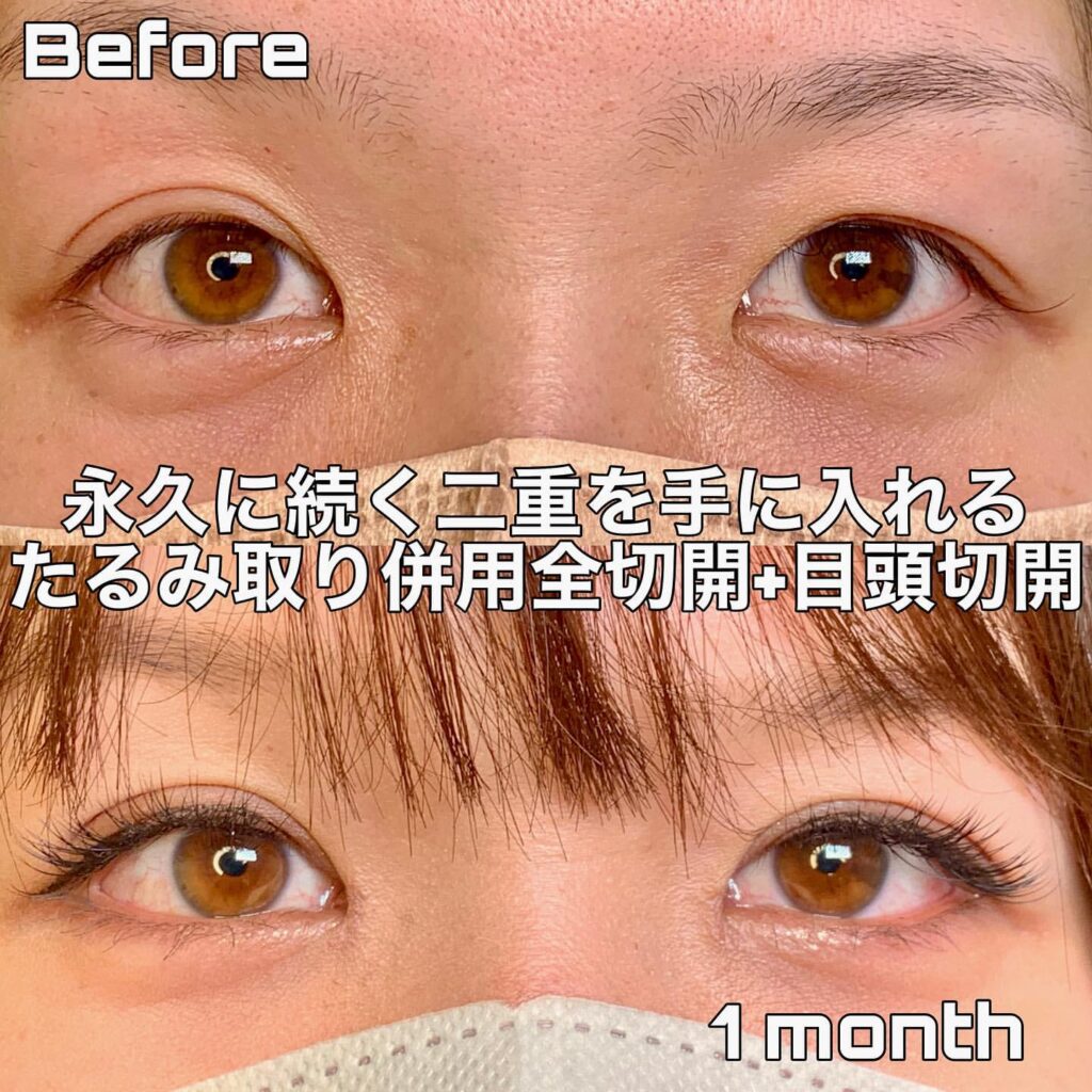 eclinic京都院のたるみ取り併用全切開二重術+目頭切開
