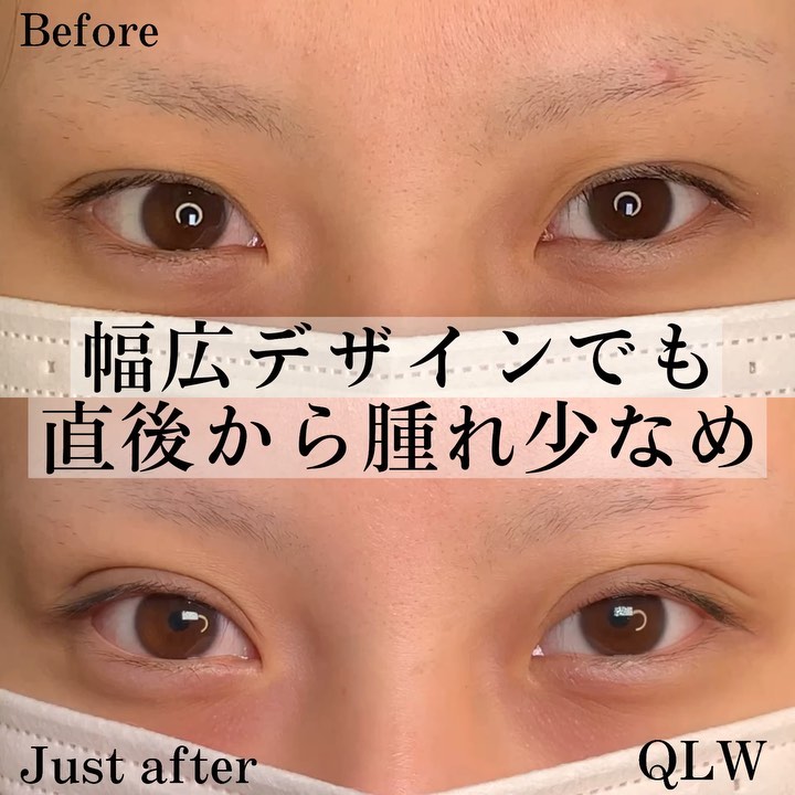 eclinic京都院の二重埋没法(クイックダブルループ法)(裏留め4点)