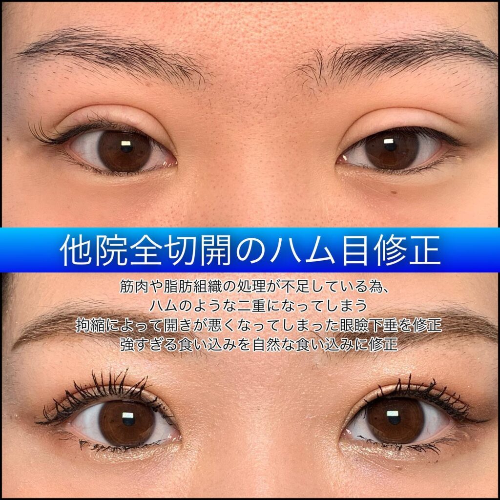 eclinic京都院の全切開二重術の他院修正(ハム目修正)