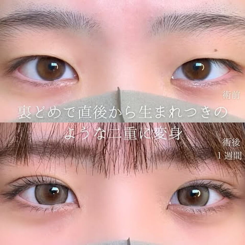 eclinic京都院の二重埋没法