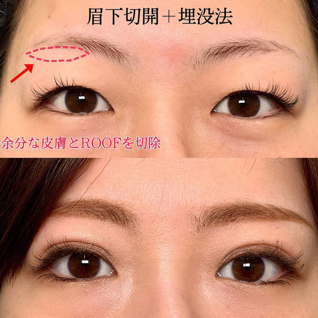 eclinic京都院の二重埋没法+眉下切開