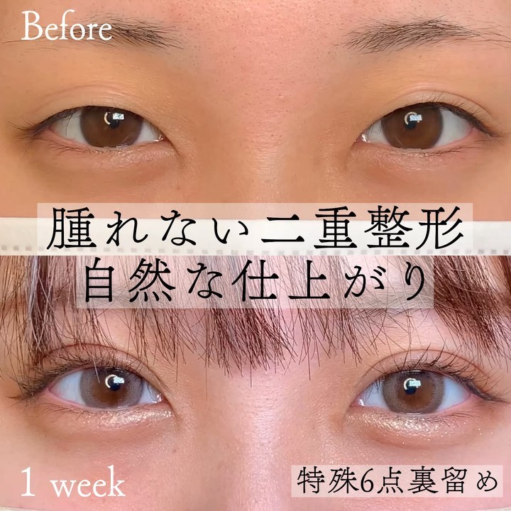 eclinic京都院の二重埋没法(特殊6点裏留め)