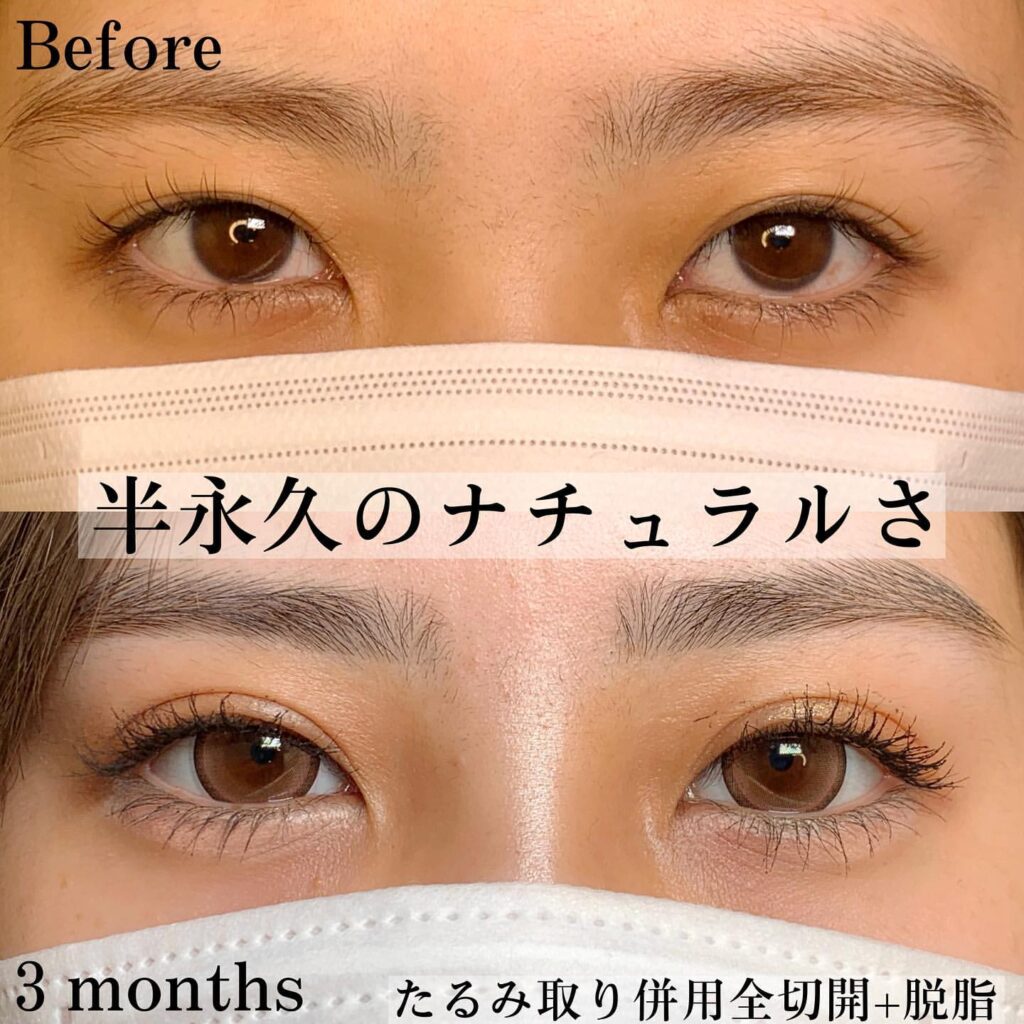 eclinic京都院のたるみ取り併用全切開二重術+脱脂
