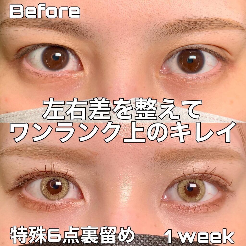 eclinic京都院の二重埋没法(特殊6点裏留め)