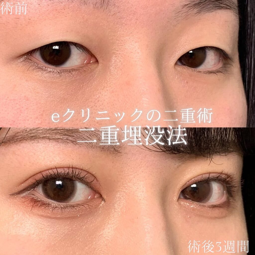 eclinic京都院の二重埋没法