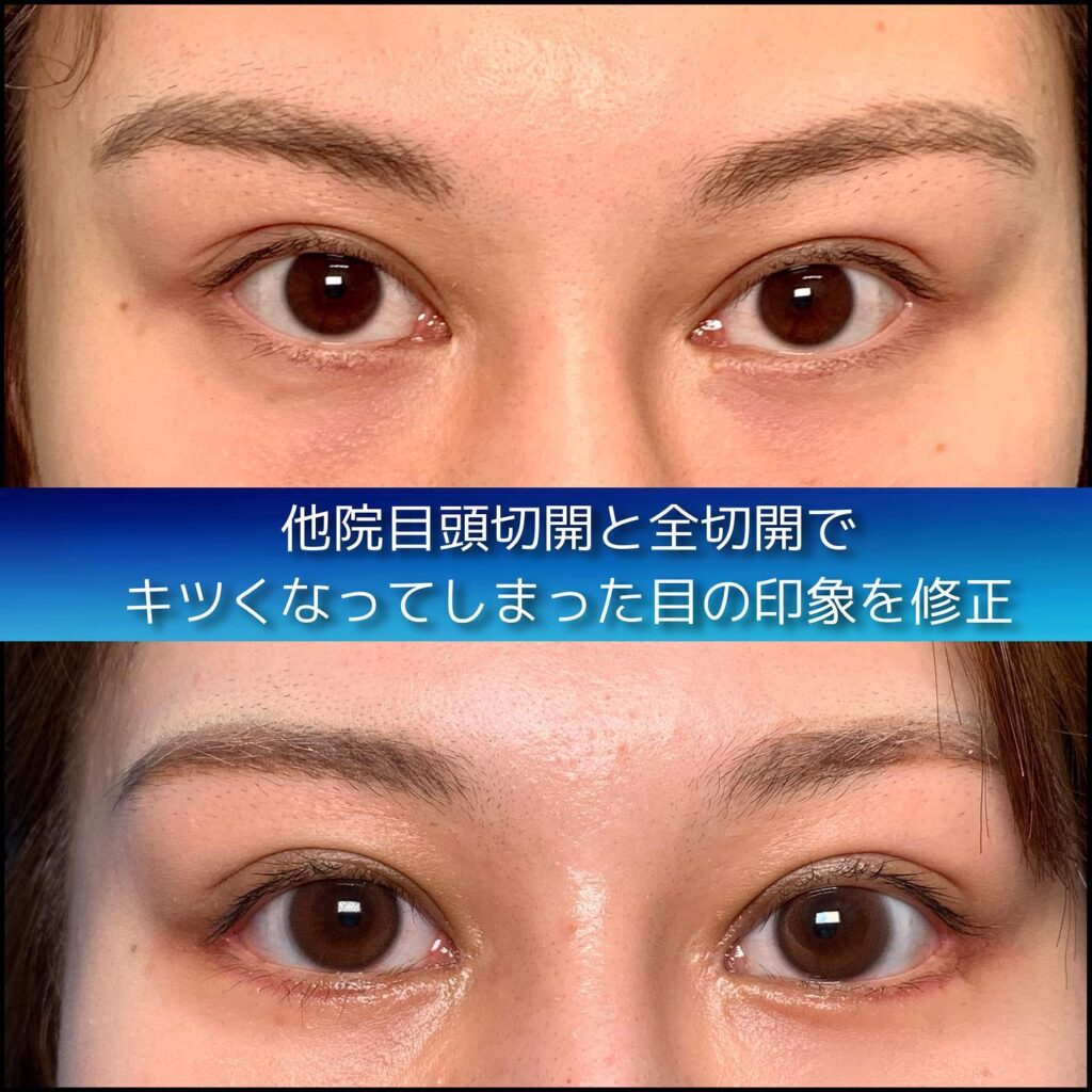 eclinic京都院の全切開二重術の他院修正+眼瞼下垂