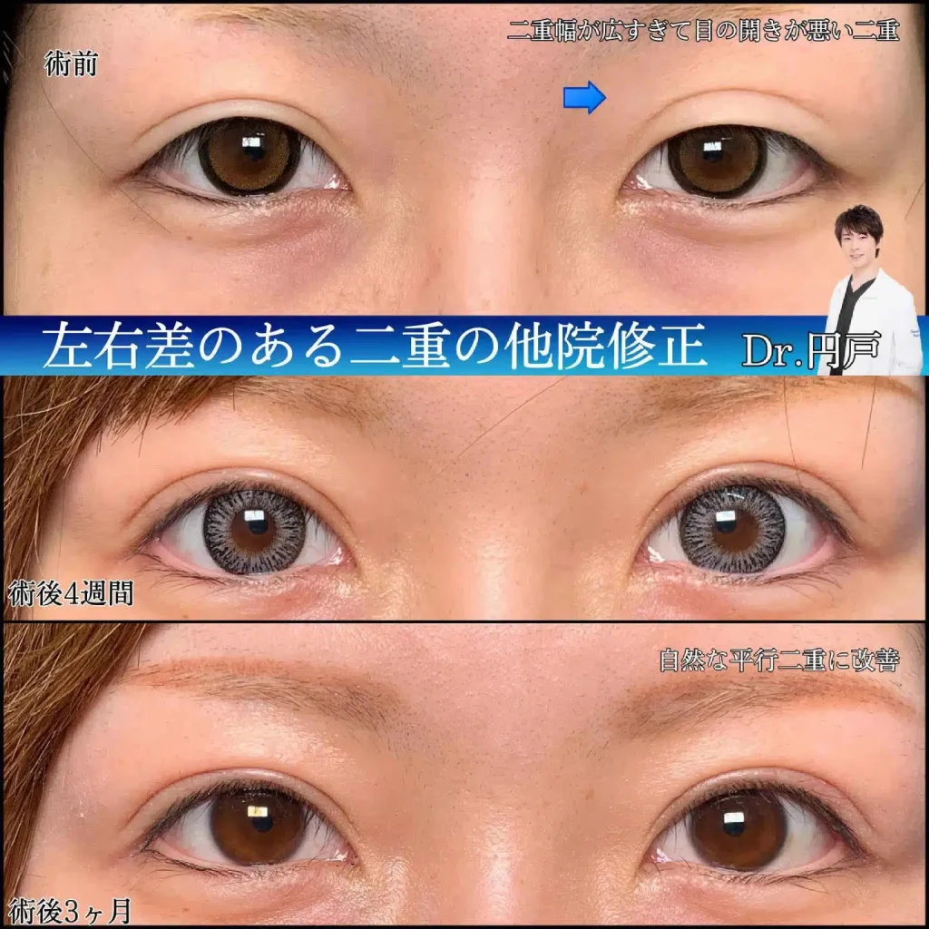 eclinic京都院の全切開二重術の他院修正