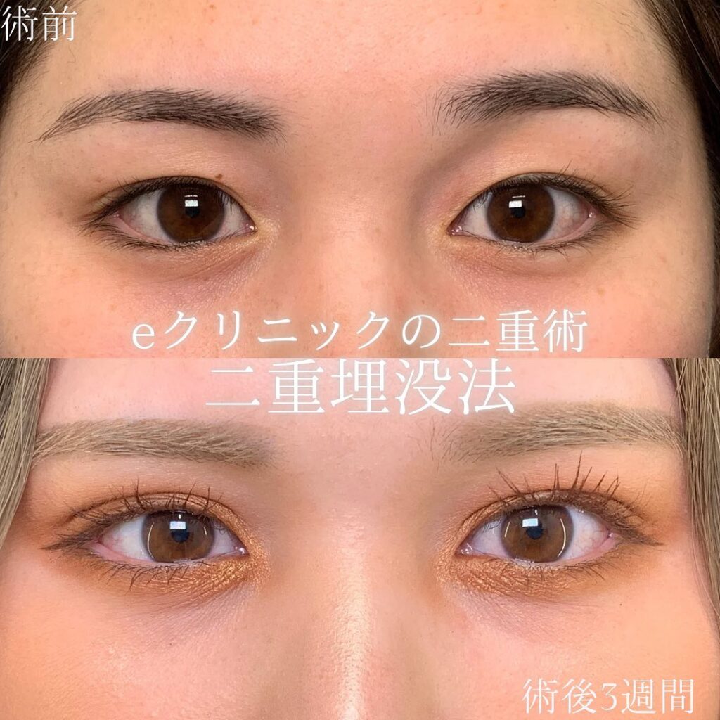 eclinic京都院の二重埋没法