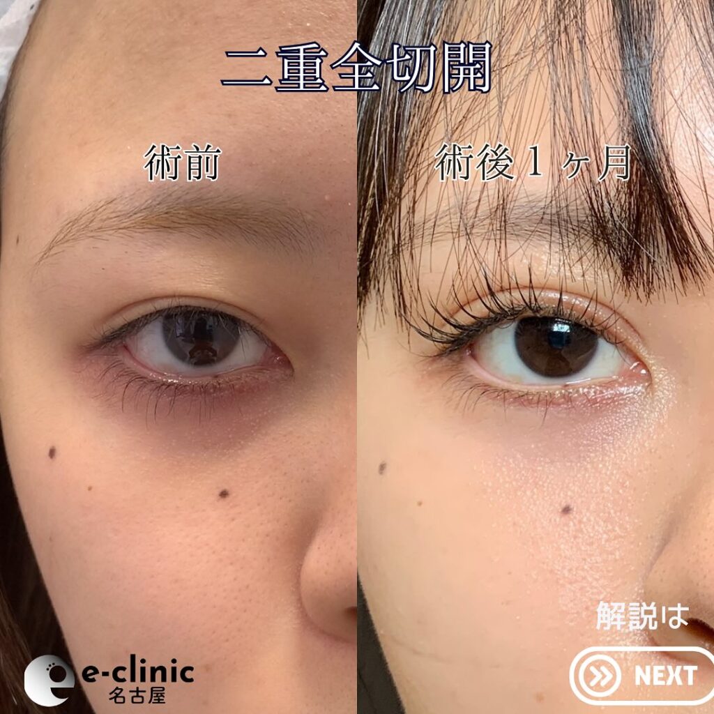eclinic京都院の全切開二重術