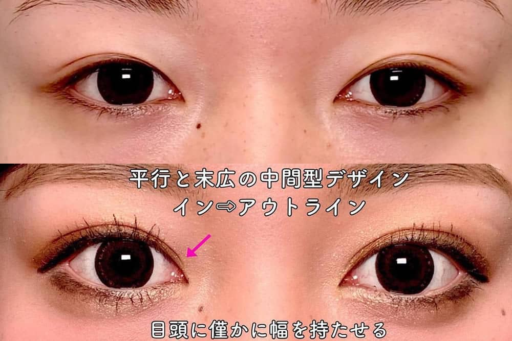 eclinic京都院の二重埋没法