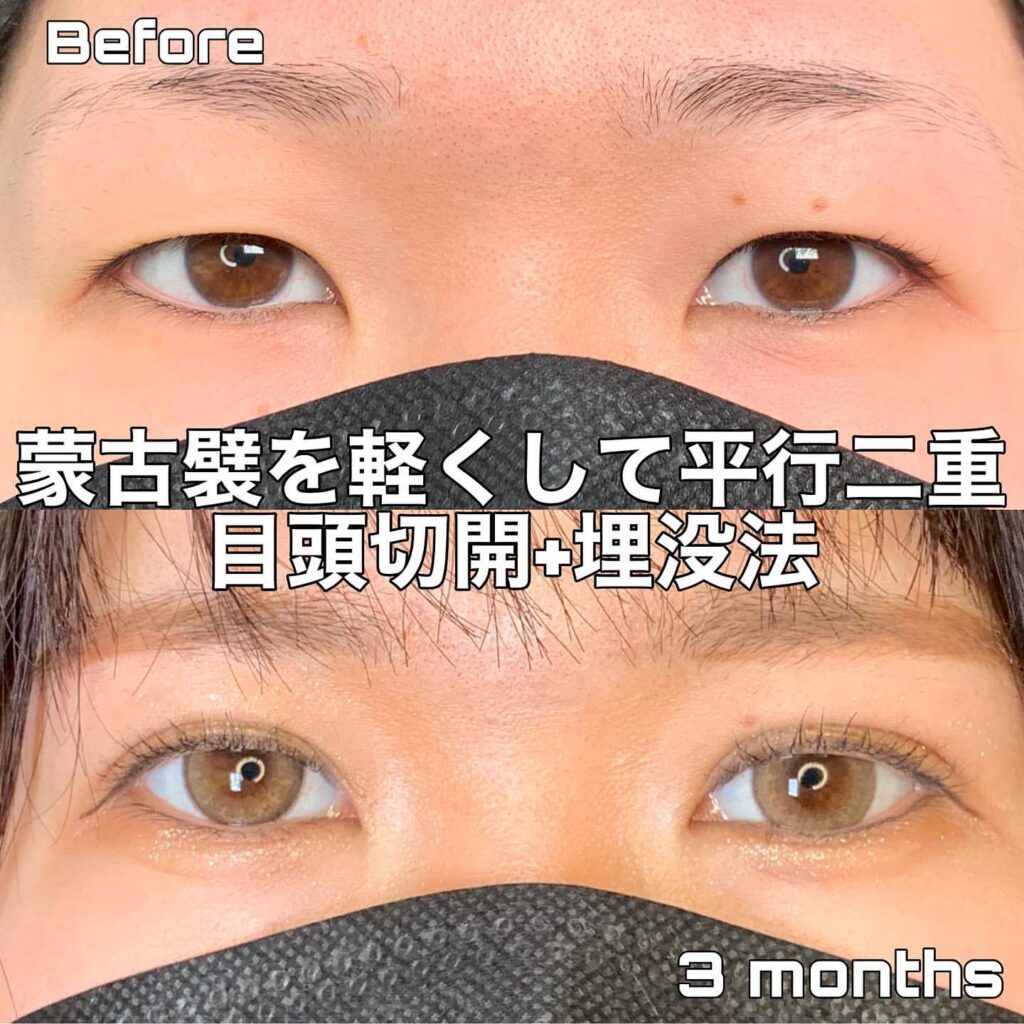 eclinic京都院の二重埋没法+目頭切開