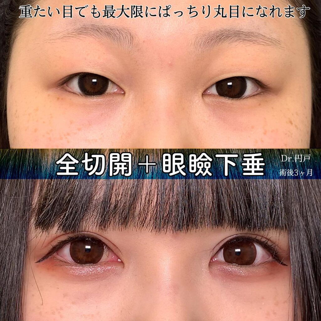 eclinic京都院の二重埋没法