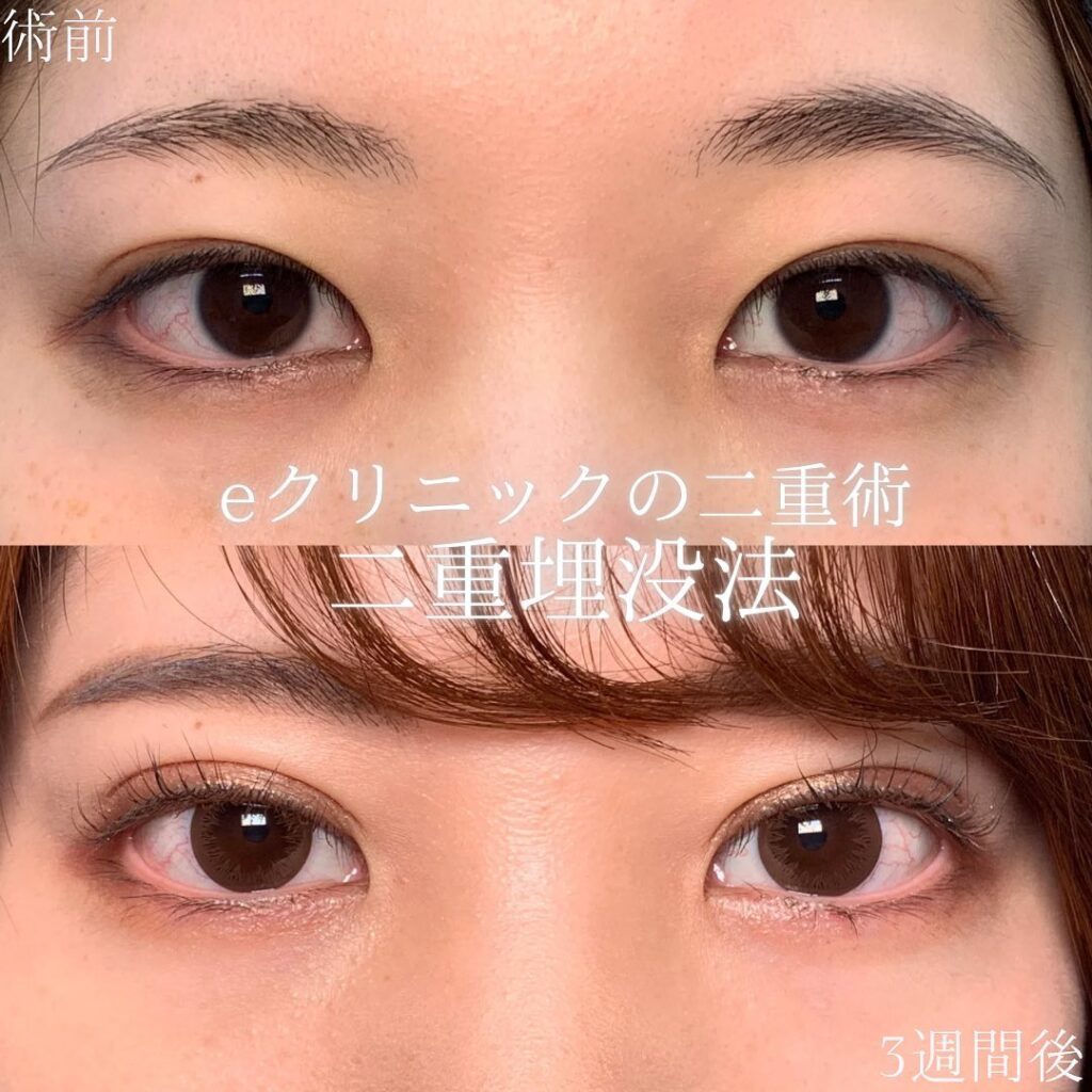 eclinic京都院の二重埋没法