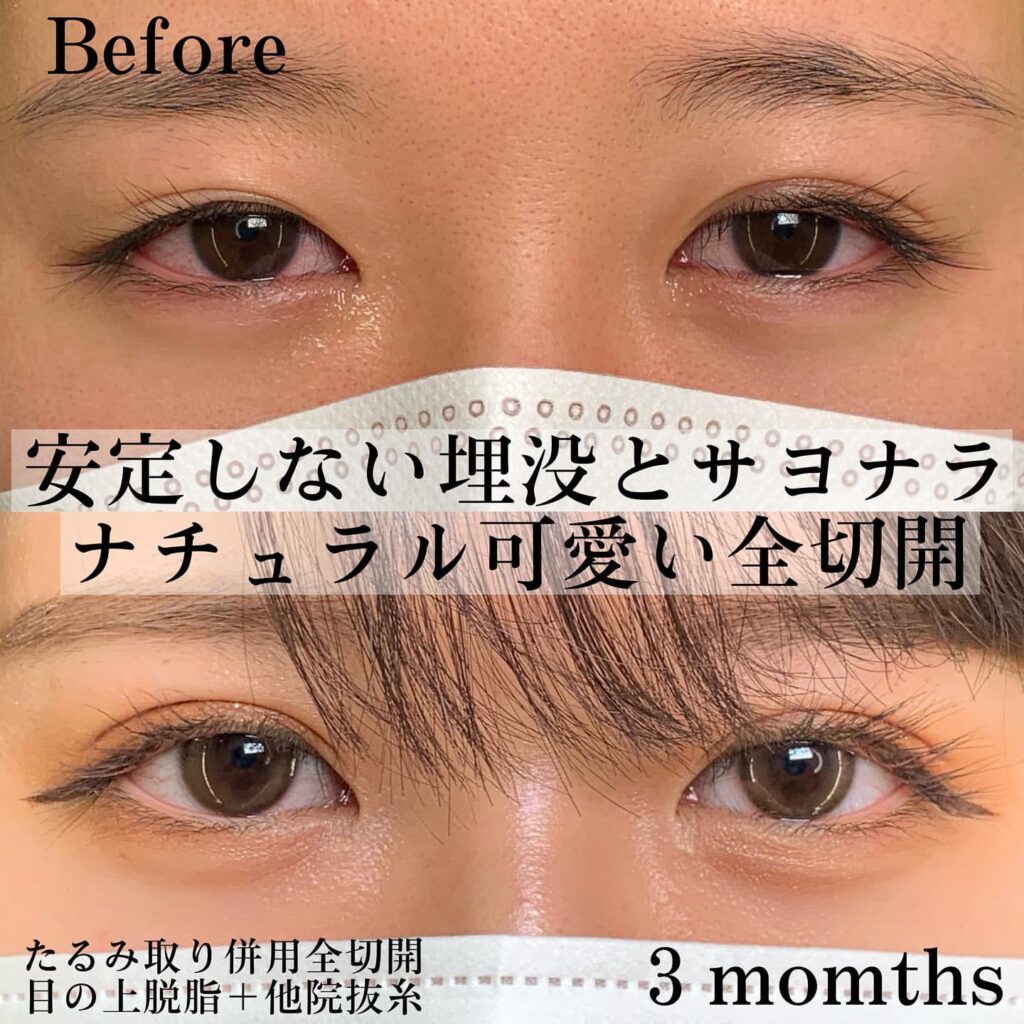 eclinic京都院のたるみ取り併用全切開二重術の他院修正+目の上脱脂+他院埋没抜糸