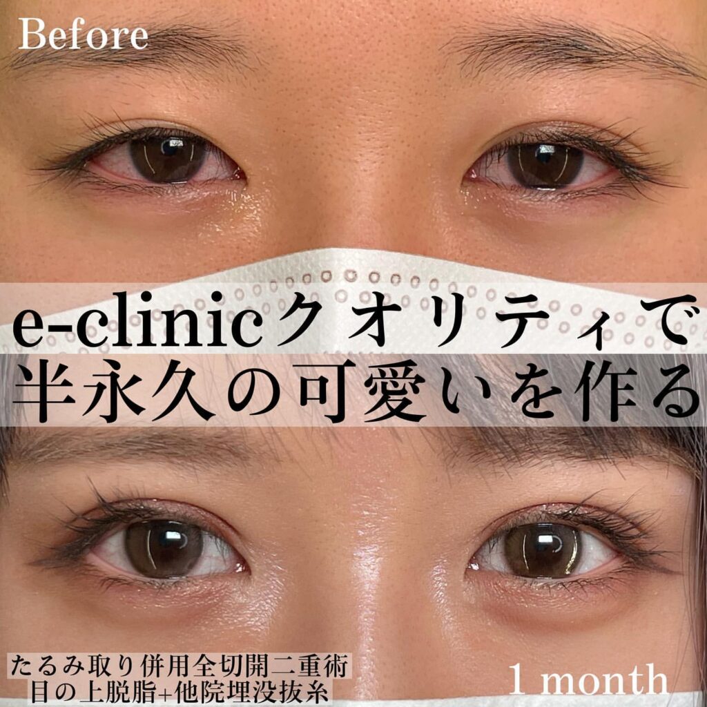 eclinic京都院のたるみ取り併用全切開二重術+目の上脱脂+他院埋没