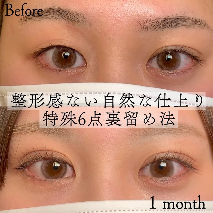 eclinic京都院の二重埋没法(特殊6点裏留め法)
