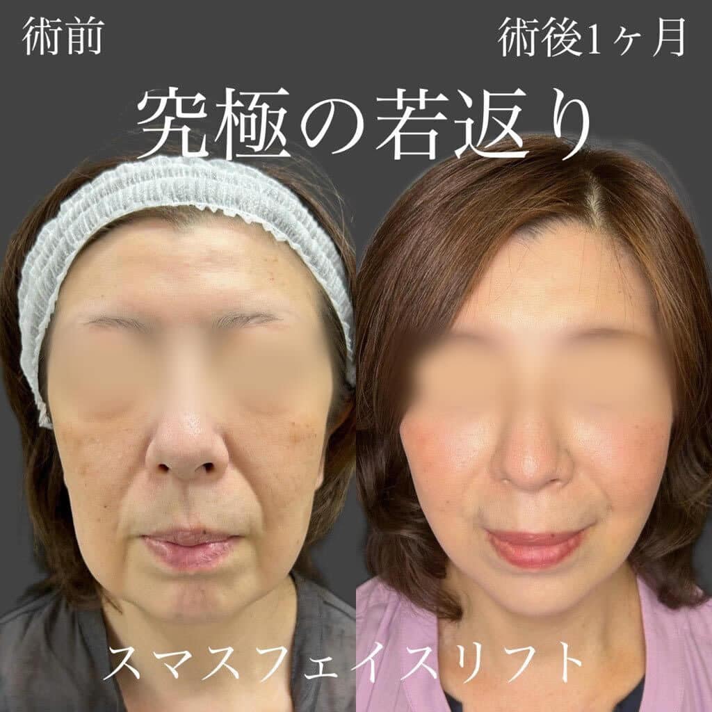 切開フェイスリフトの症例
