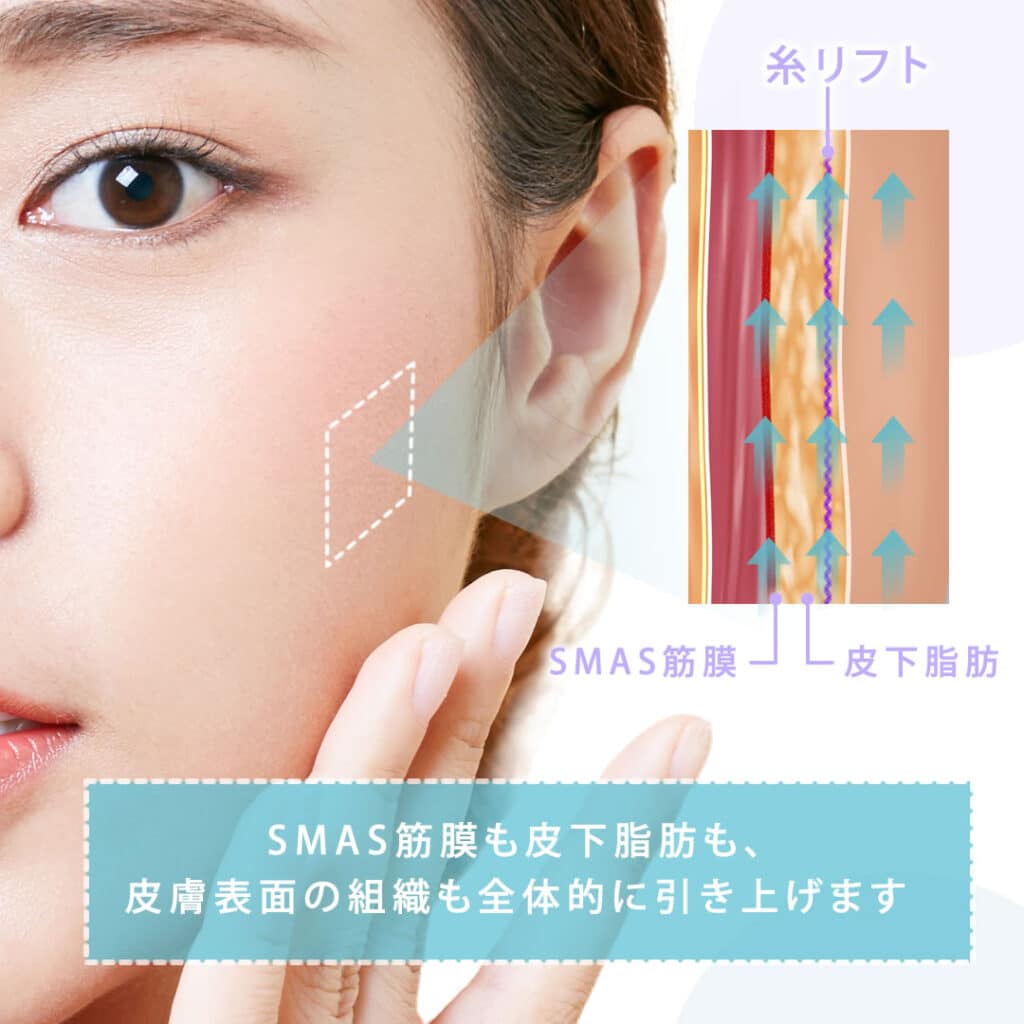 SMAS筋膜と皮下脂肪を上げる図解