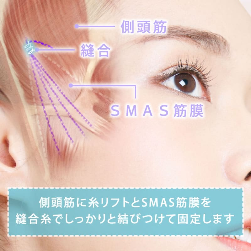 側頭筋に縫い付ける図解
