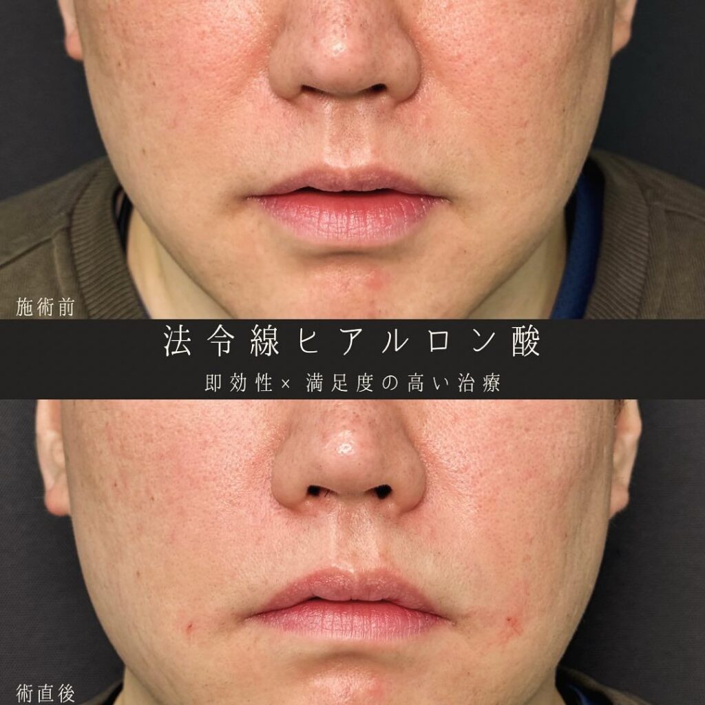 法令線にヒアルロン酸を注入した症例写真 (1)