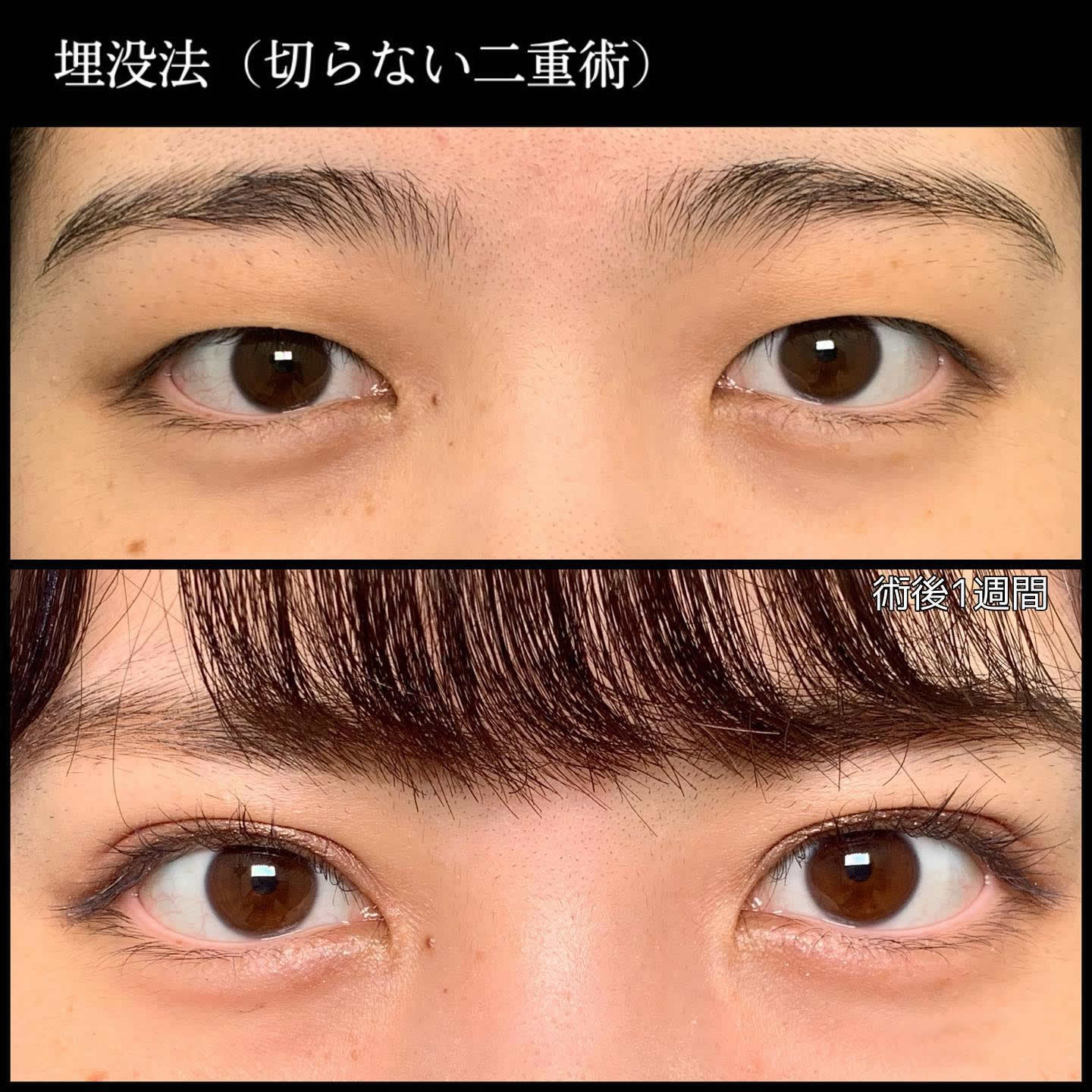 京都院の埋没法の症例 (1)