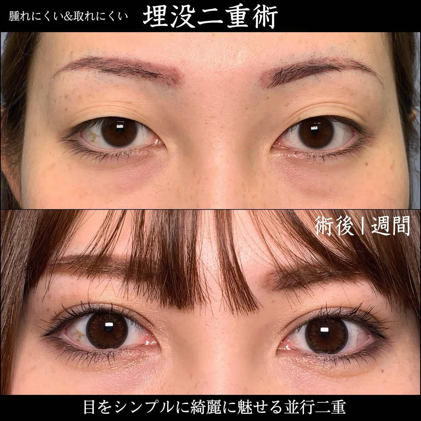 京都院の30代の埋没法の症例 (5)