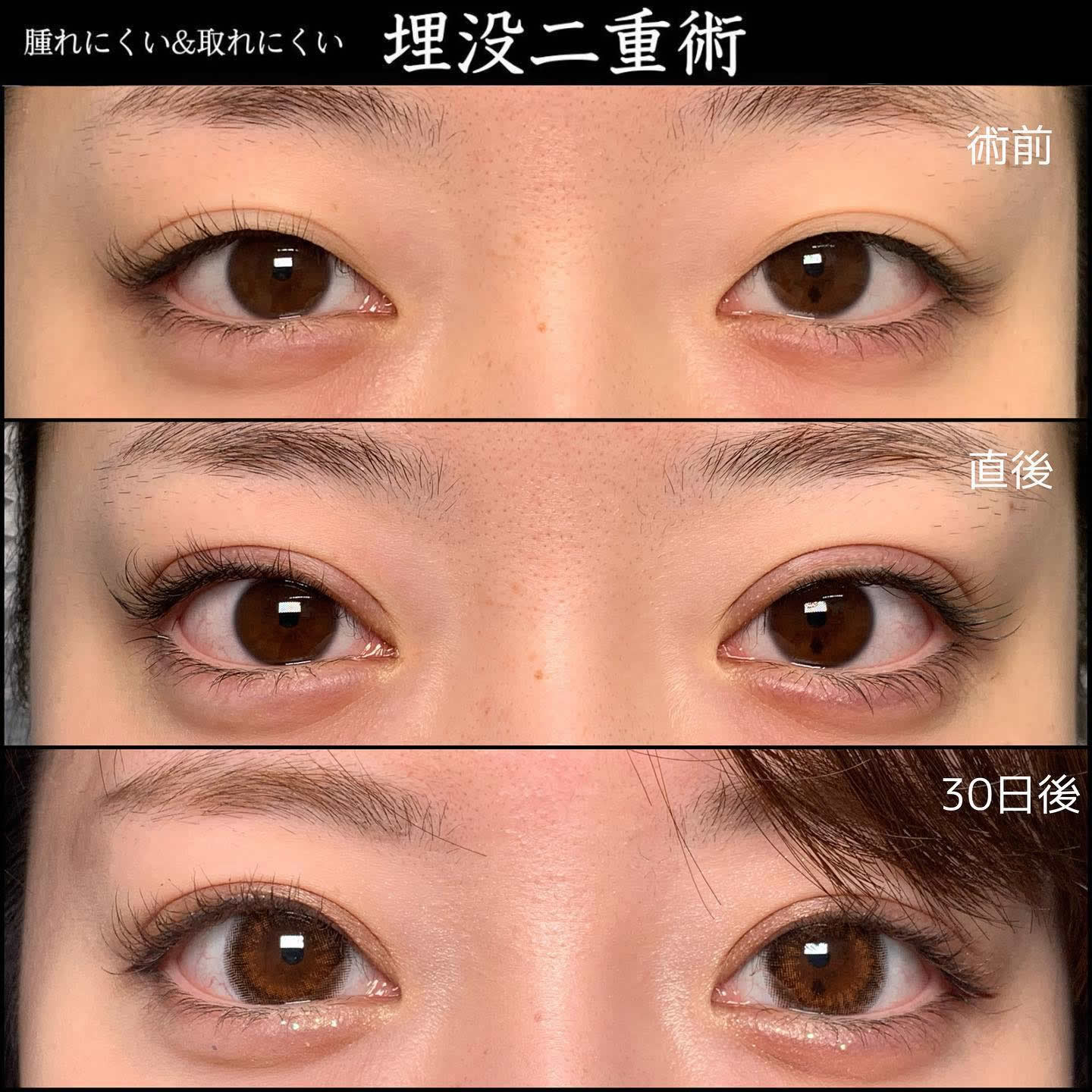 京都院の20代の取れない埋没法の症例 (6)