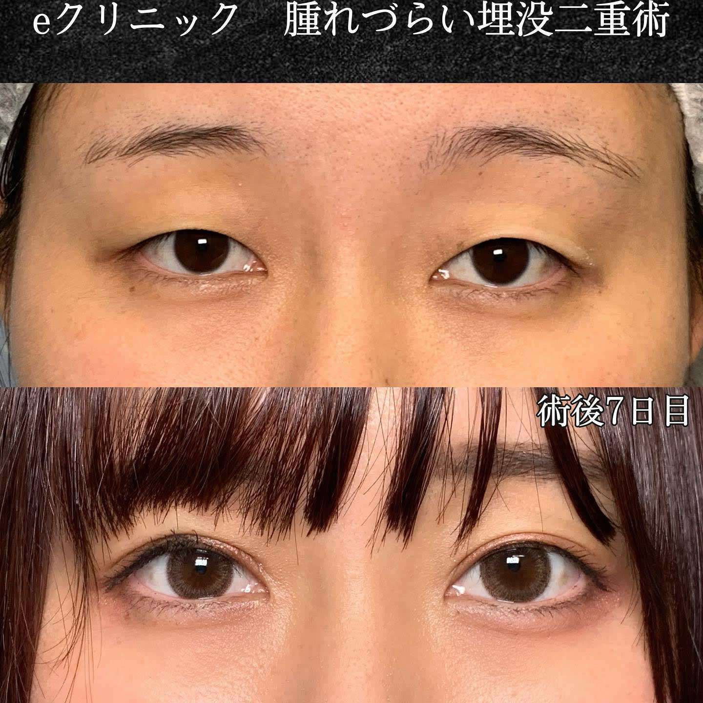 京都院の埋没法の20代女性の症例写真