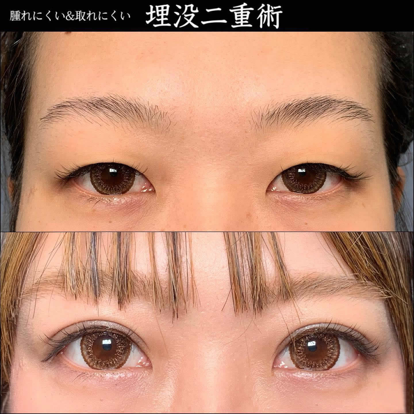 京都院の20代の腫れにくい埋没法の症例 (7)