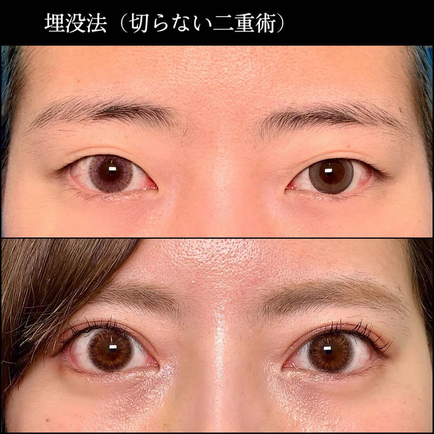 京都院の20代の埋没法の症例 (2)