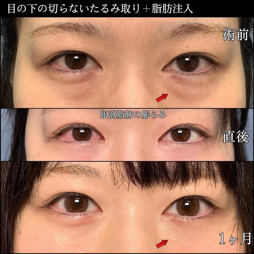 クマ取りの術後と1ヶ月後の症例