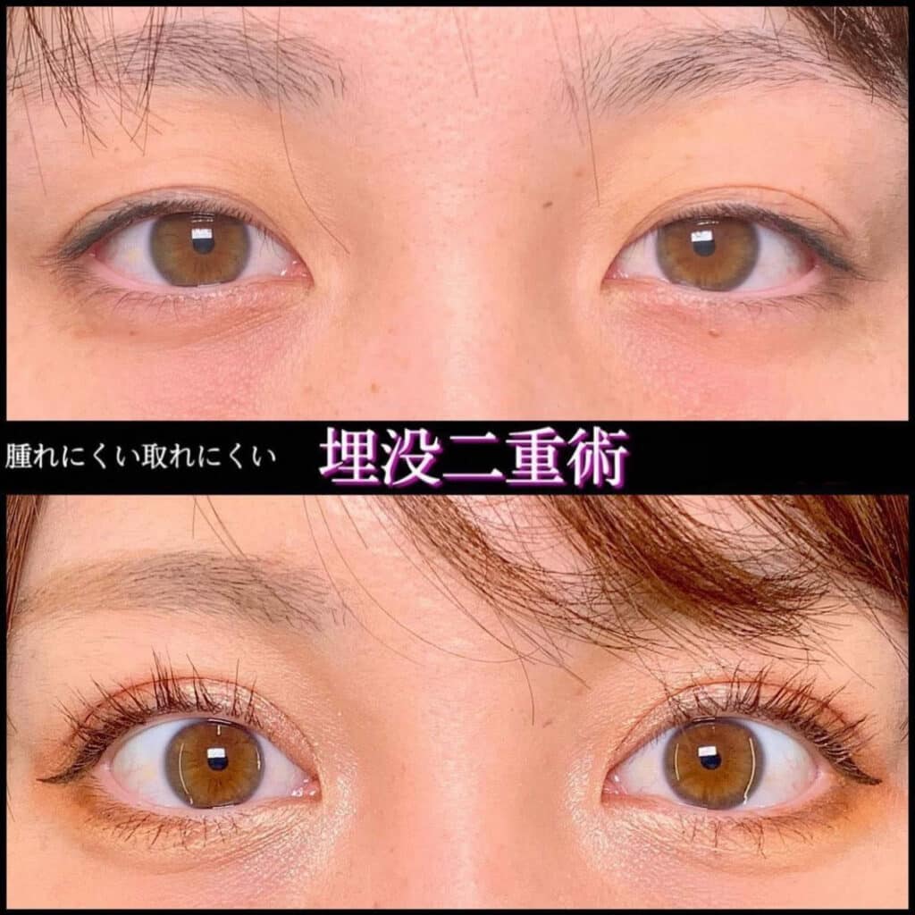 可愛くなった京都院の埋没法の症例写真