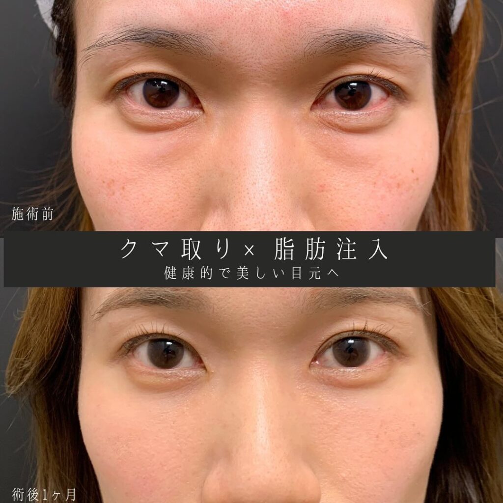 eクリニック京都院のクマ取りと脂肪注入の症例