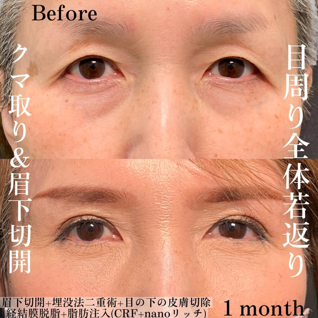 eクリニック京都院の経血膜脱脂の症例写真(4)