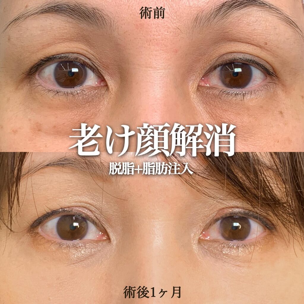 経結膜脱脂と脂肪注入の症例