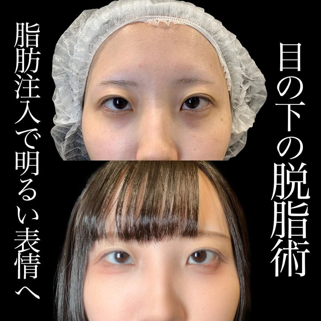 脱脂と脂肪注入の症例写真