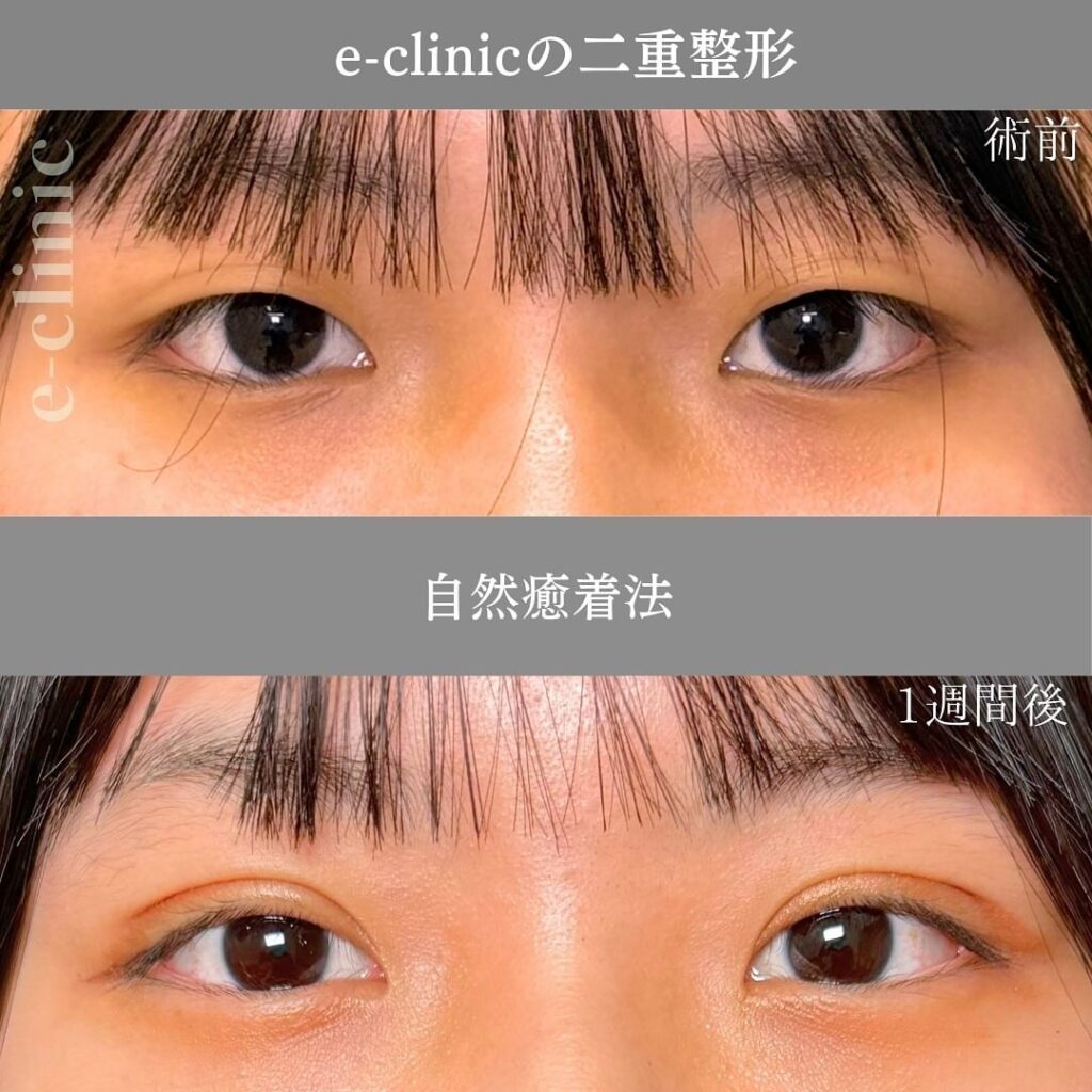自然癒着法の症例
