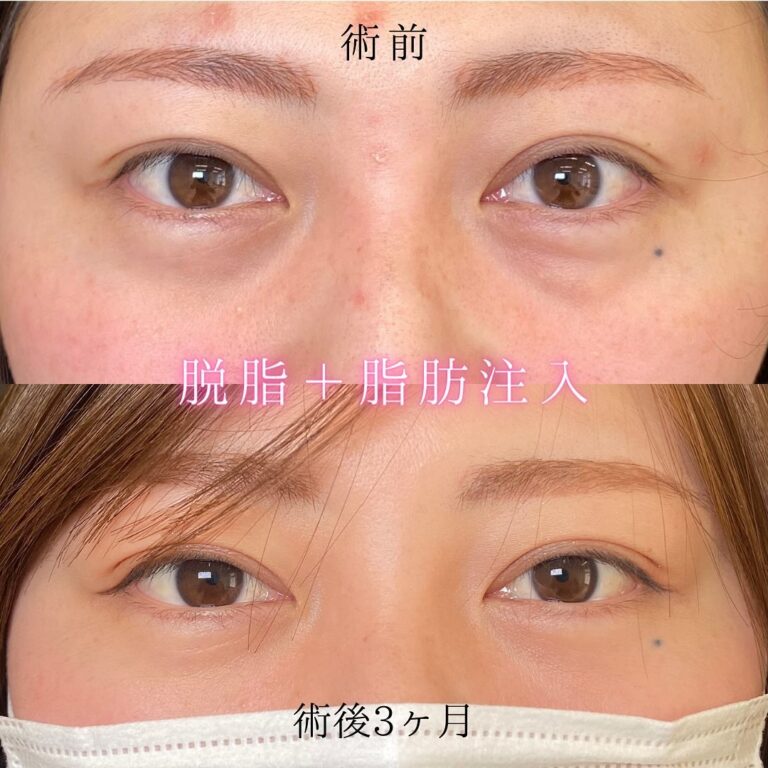 eクリニック京都院の経血膜脱脂の症例写真(5)