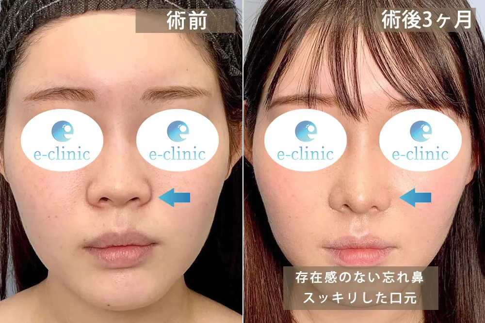 ほうれい線（⿐翼)基部プロテーゼ・人工真皮 ｜貴族手術