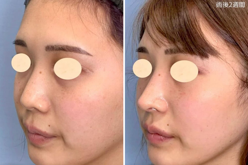 肋軟骨移植による鼻中隔延長