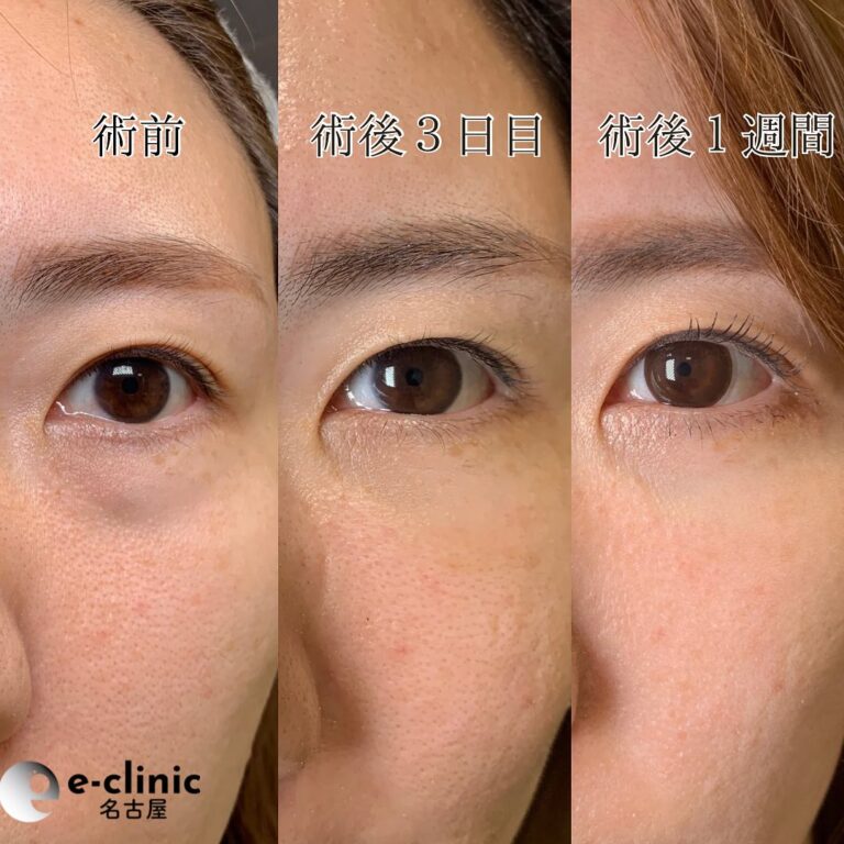eクリニック京都院の経血膜脱脂の症例写真(6)