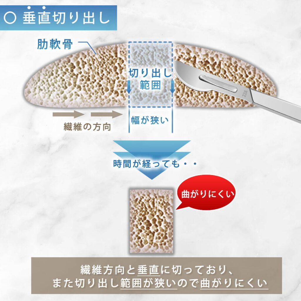 肋軟骨の垂直切り出しの図解