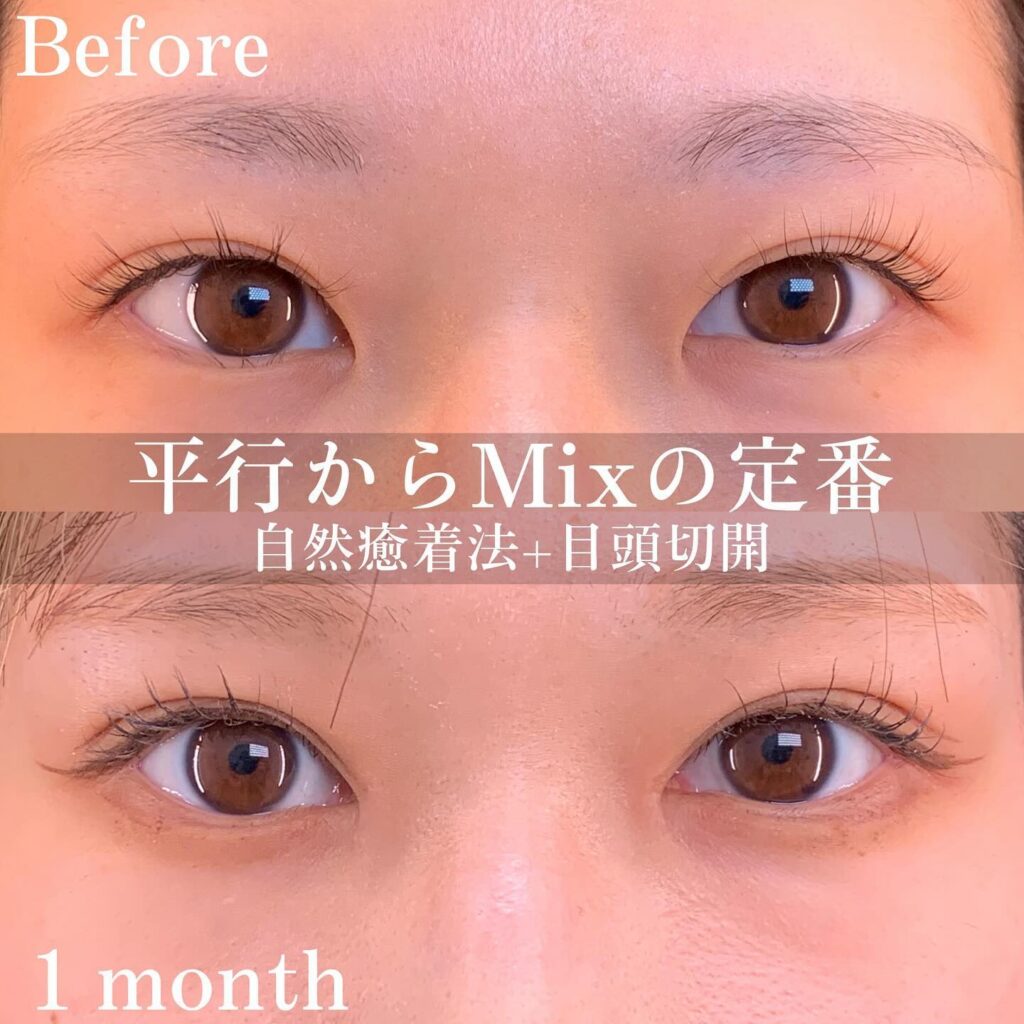 自然癒着法と目頭切開の症例写真 (2)